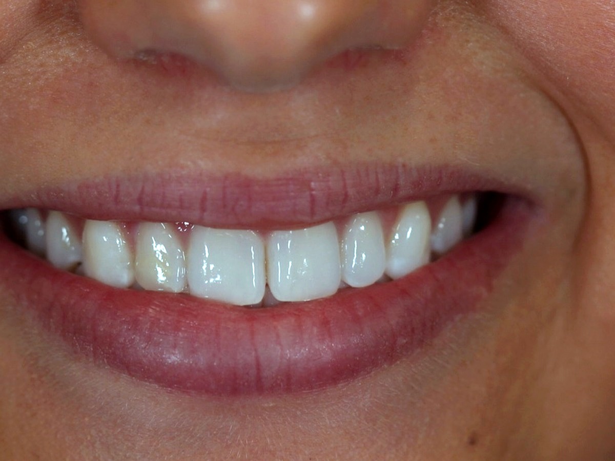Before — spacing between front teeth