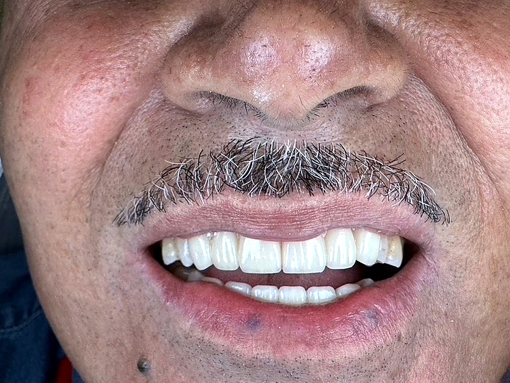 After — full-mouth reconstruction with bridgework, crowns and veneers