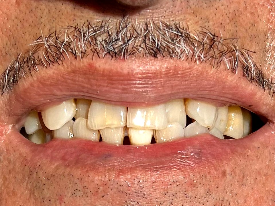 Before — failing dentition from long-standing periodontal disease