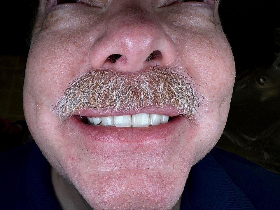 After — full-mouth restoration with veneers and crowns