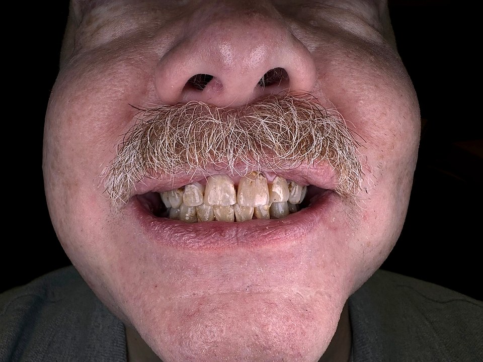 Before — worn, discolored teeth from compromised enamel