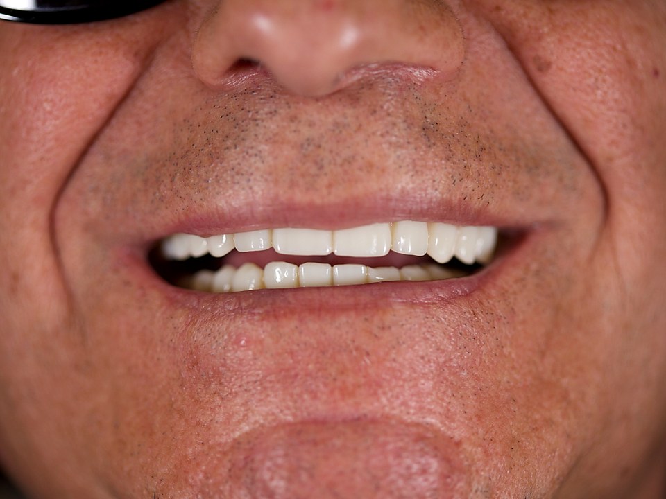After — full-arch implant reconstruction with a fixed prosthesis