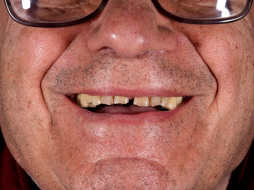 Before — failing dentition with broken and missing teeth
