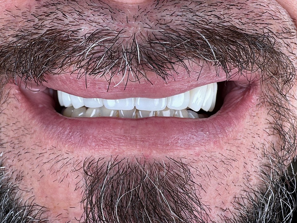 After — bridges and crowns restoring bite support and natural tooth length