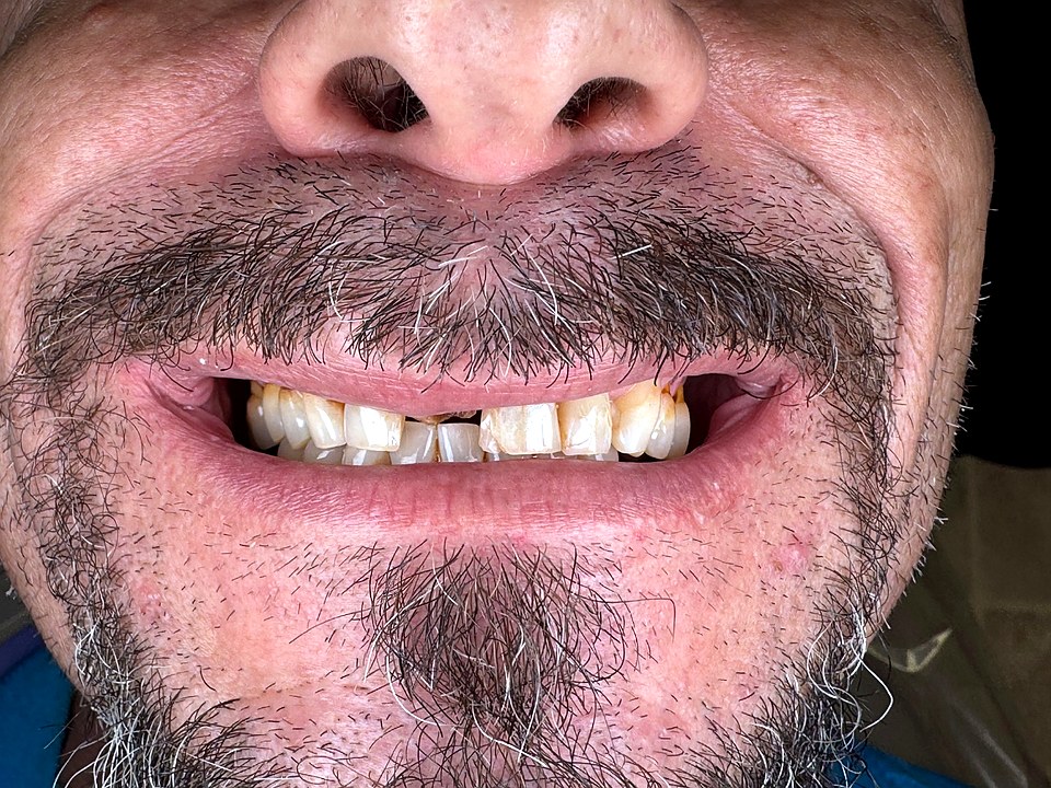 Before — worn, collapsed anterior teeth from missing posterior support