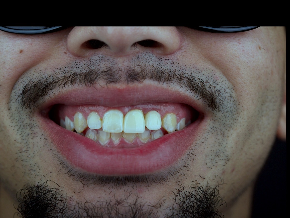 After — implant-supported porcelain crowns restoring the front smile