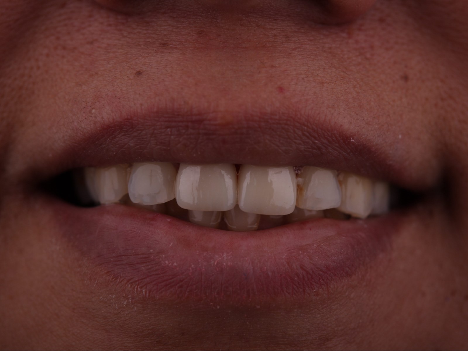 After — new porcelain veneers and a crown restoring a uniform shape and color