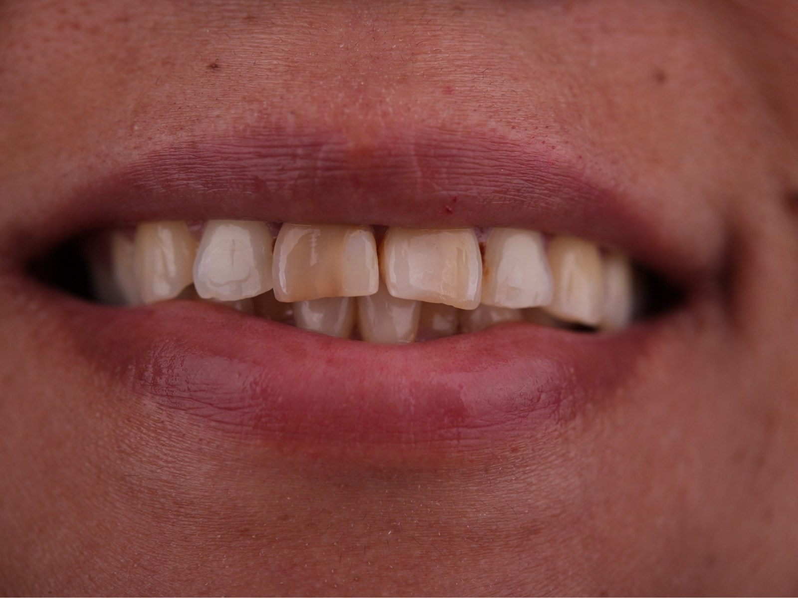 Before — worn, discolored composite bonding on the upper front teeth with uneven edges