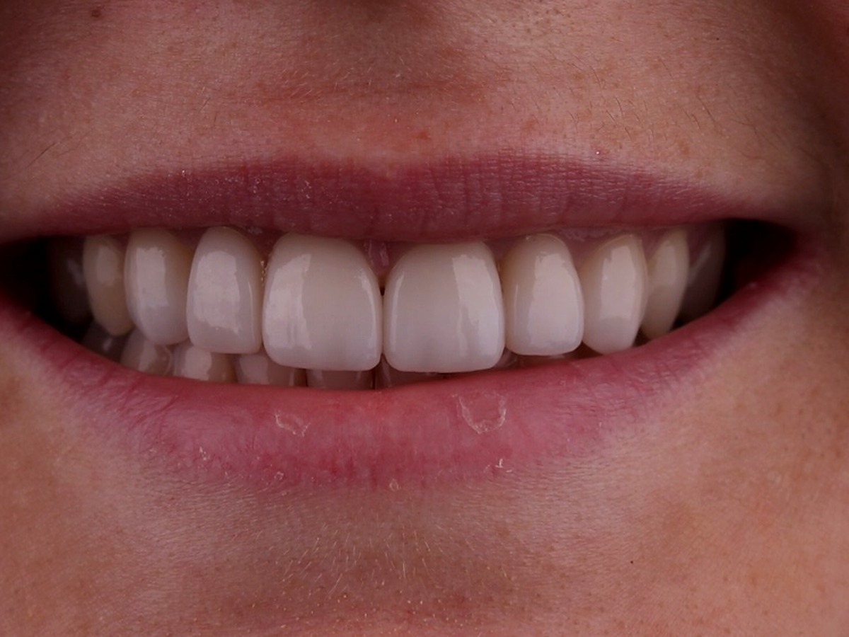 After — six uniform porcelain veneers from canine to canine, brighter and more uniform